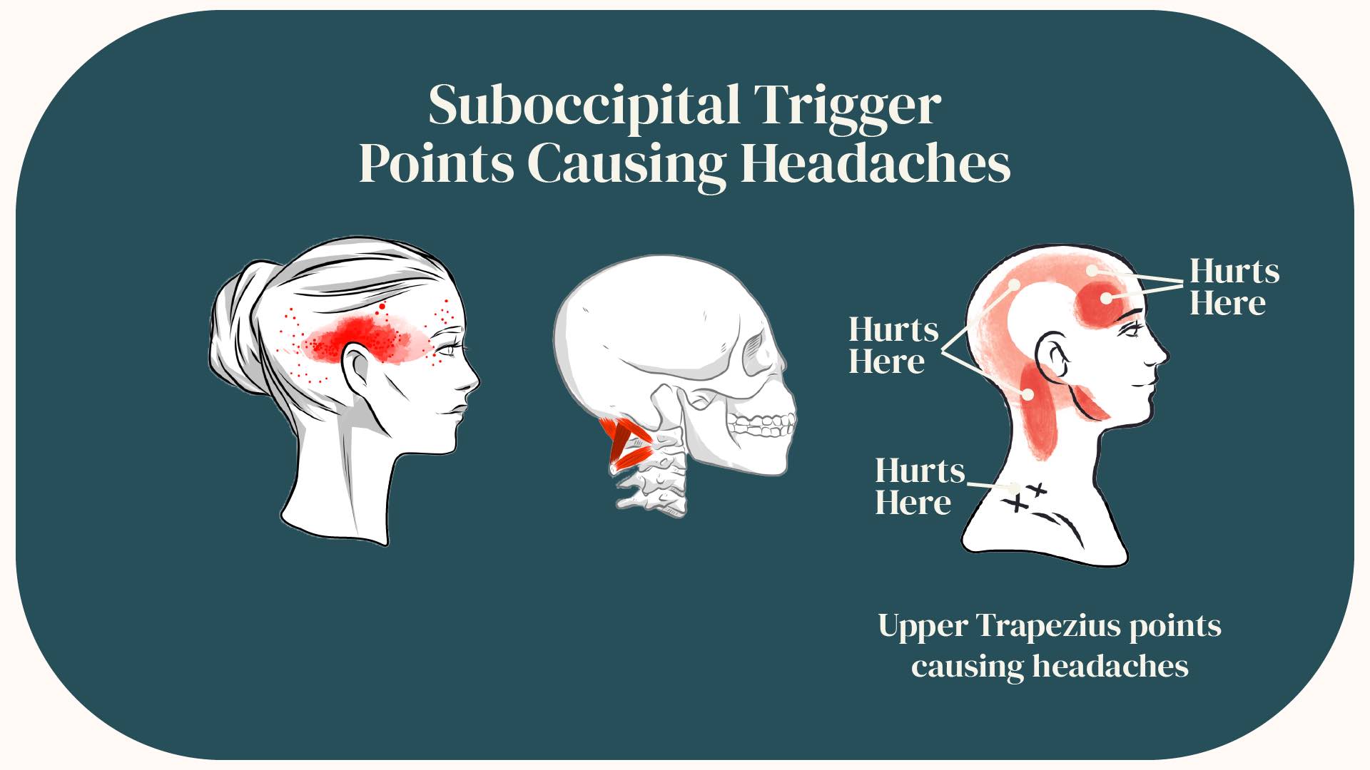 Suboccipital Headaches: What are they? - Pure Chiropractic Mentone